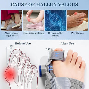 FeetifFix – Bunion Toe Corrector | مصحح تشوه الإبهام